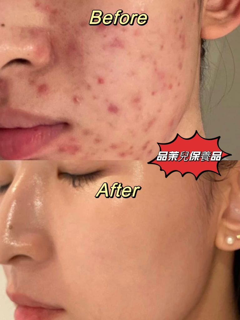 大爛痘的逆襲