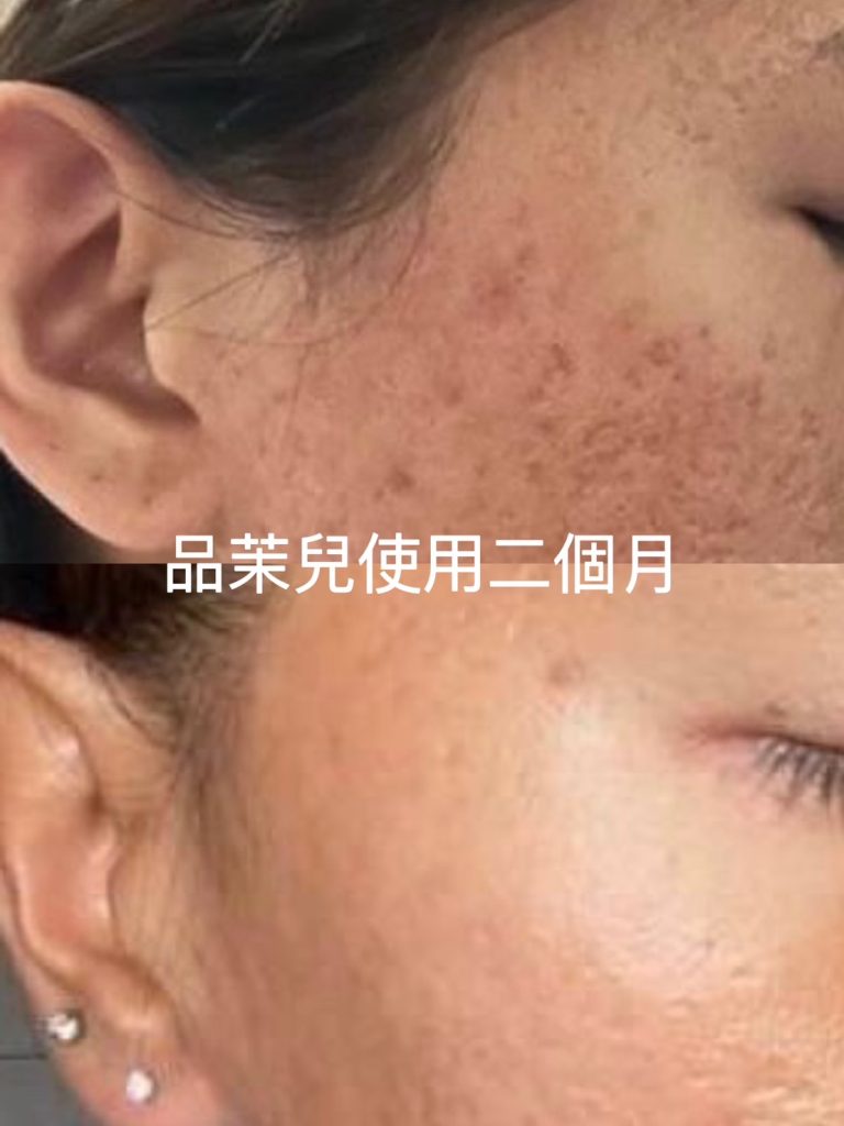 痘疤2